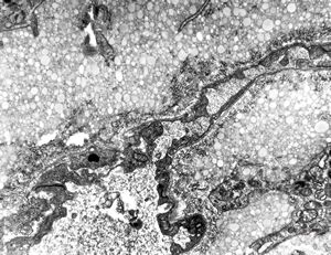 jejunum … lipid malabsorption jejunum … lipid malabsorption
